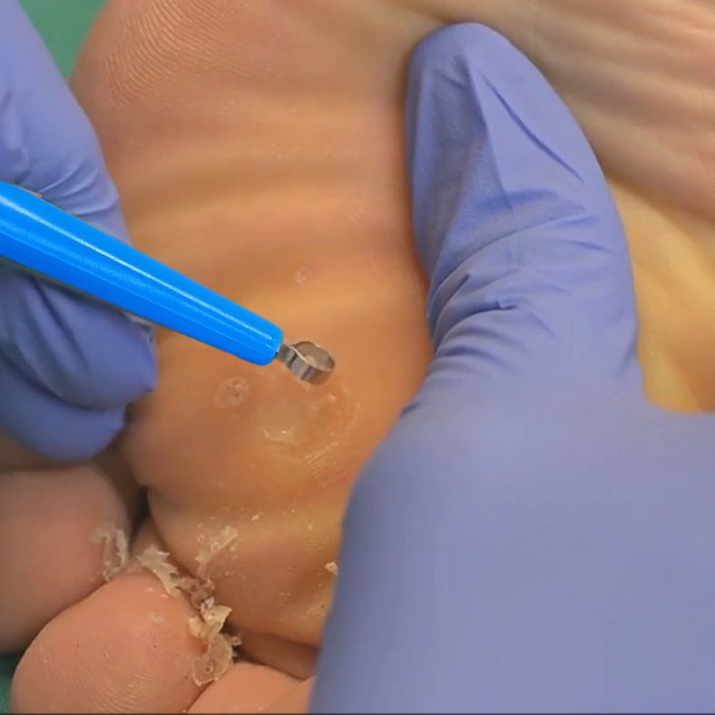 Why You Should Use a Dermal Curette for Verruca Removal