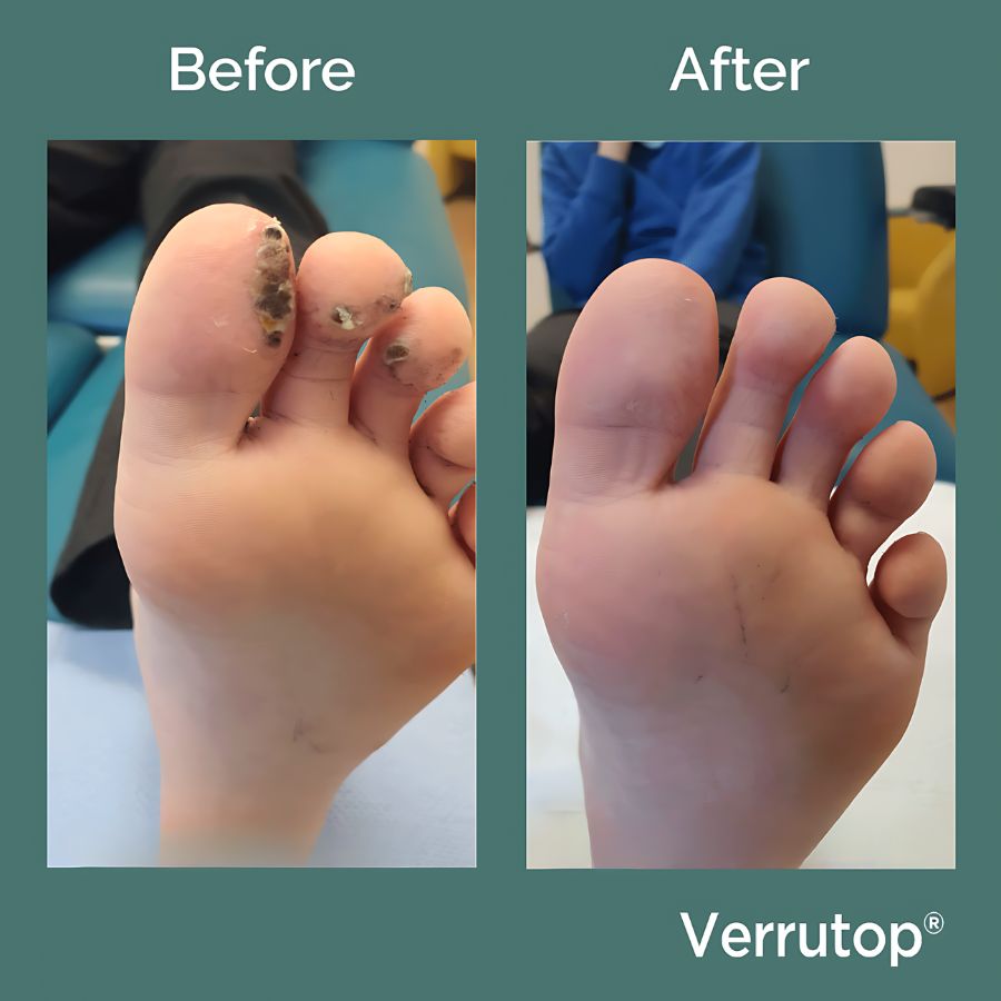 Before and after Verrutop treatment showing successful disappearance of verruca following treatment