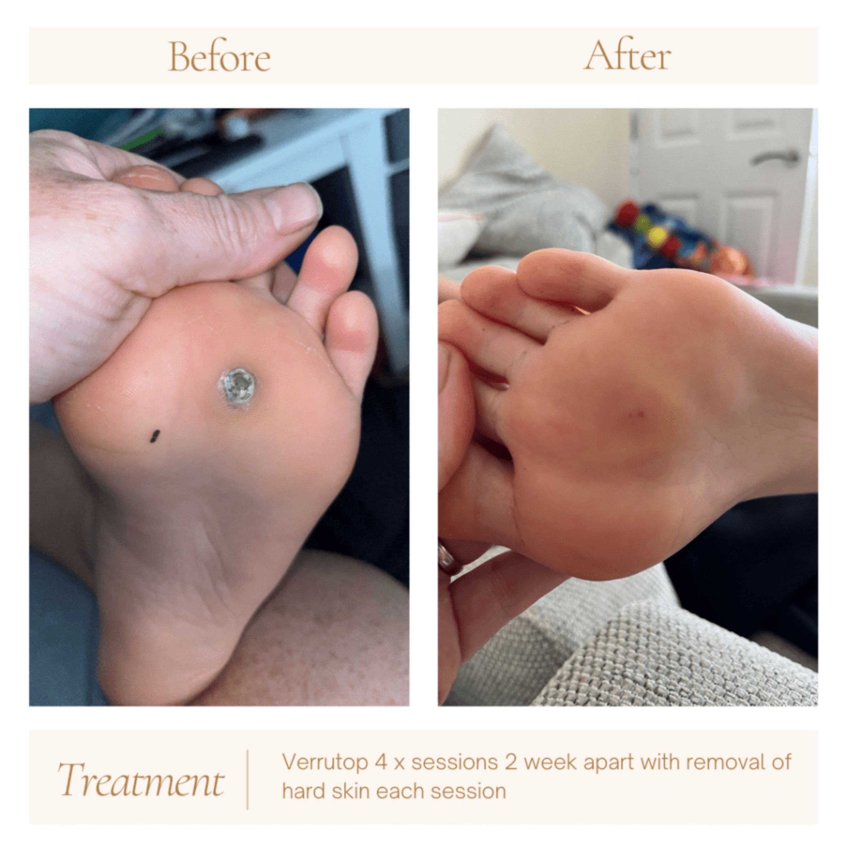 Before and after Verrutop treatment showing successful disappearance of verruca following treatment.