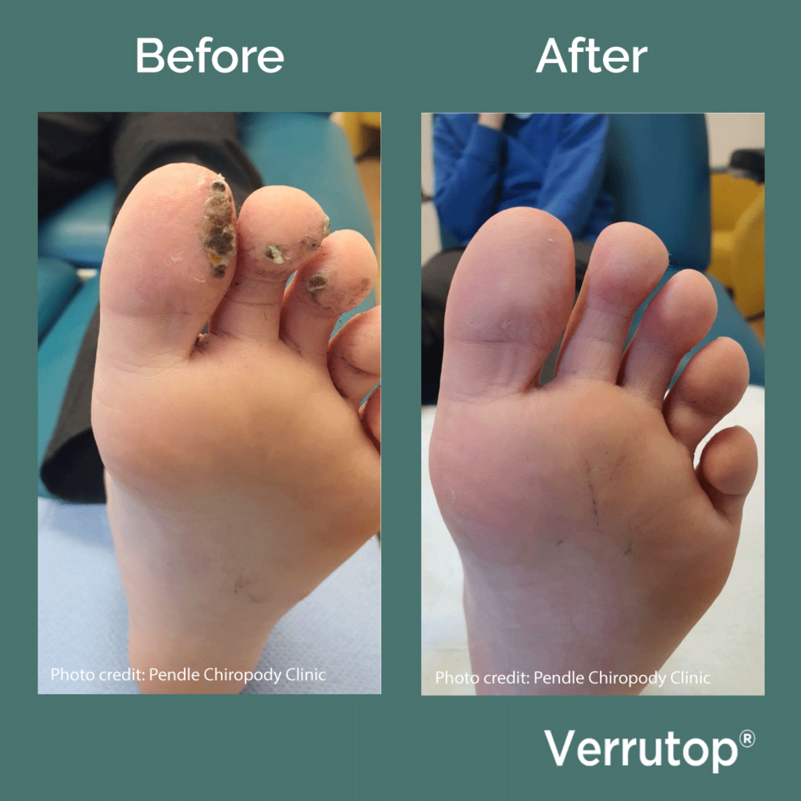 Before and after Verrutop treatment showing successful disappearance of verruca following treatment.