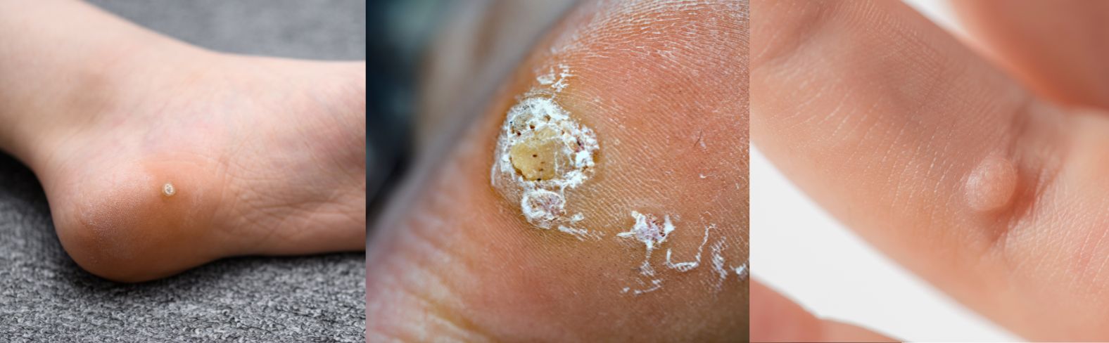 Types of plantar warts