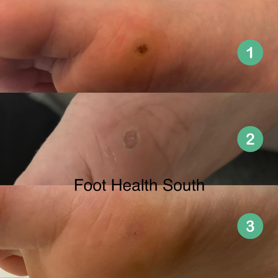 Before and after images of a verruca on a child’s foot treated with Verrutop, showing clear skin after treatment.