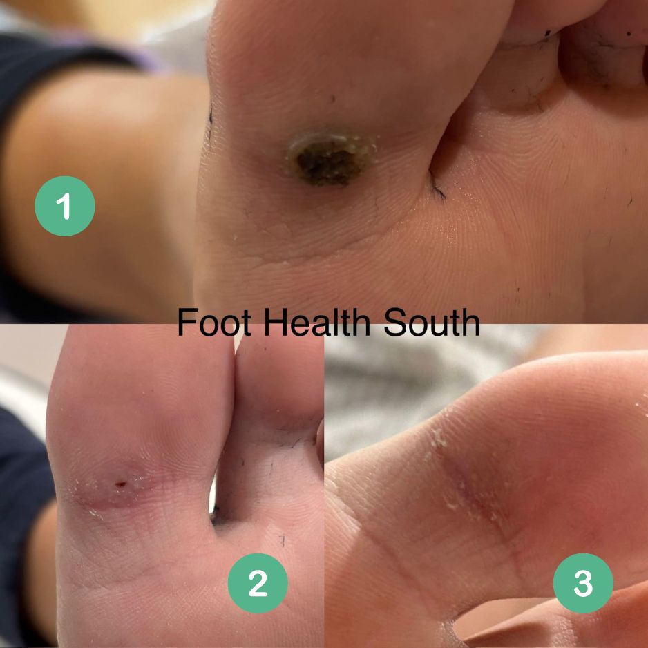 Before and after images of a verruca on a young girl's foot treated with Verrutop, showing clear skin after treatment.