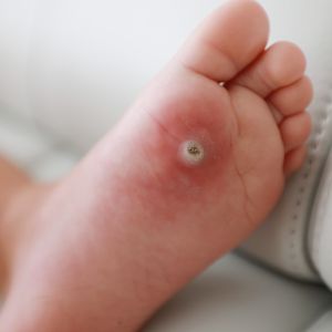 wart on a kids foot